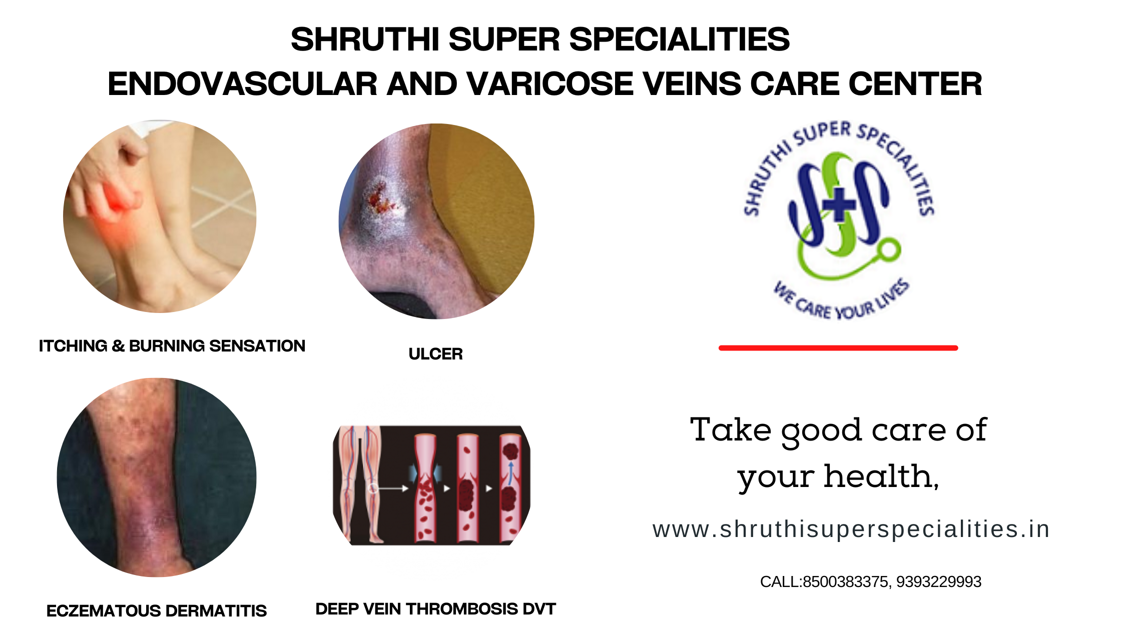Shruthi Super Specialities – Providing the Best Varicose Veins Treatment in Hyderabad